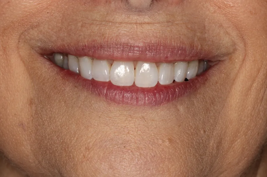 After treatment: E. B.