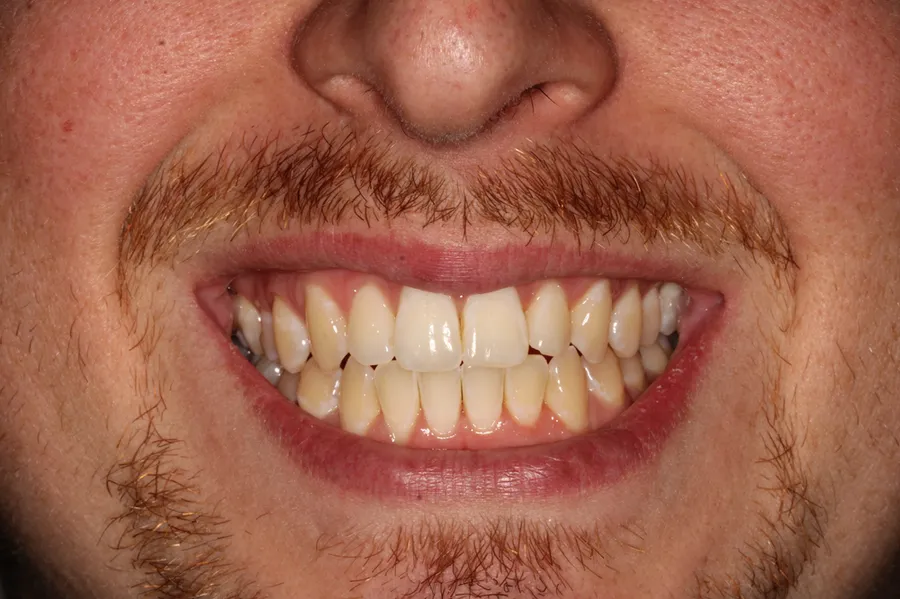 After treatment: E. M.