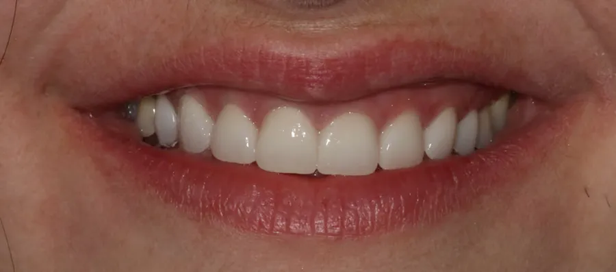 After treatment: V. E.
