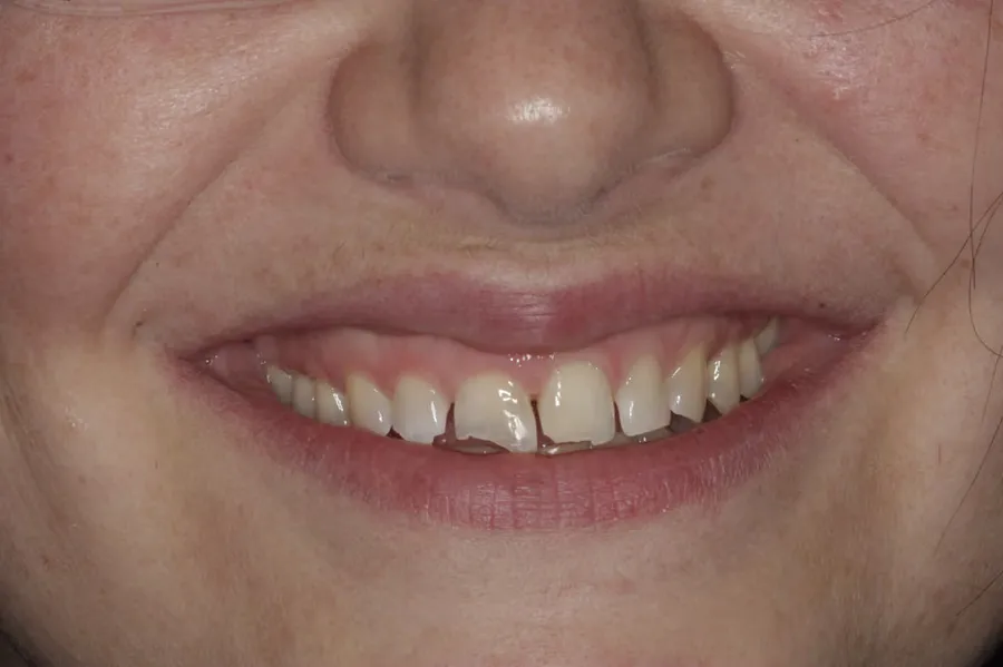 Before treatment: V. E.
